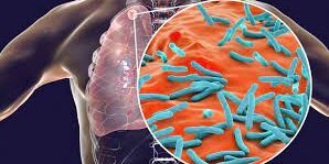 Tuberculose